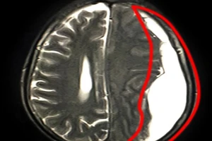 Suýt mất mạng do máu tụ dưới màng cứng mạn tính
