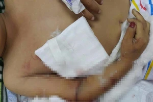 Con 5 tuổi đứt lìa tay phải do mẹ bất cẩn