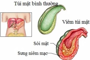 Bệnh ở túi mật và cách phát hiện sớm