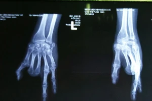 Một bàn tay có hai… ngón chân