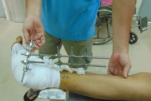 3 lần phẫu thuật cứu bàn chân dập nát do xe nâng cán