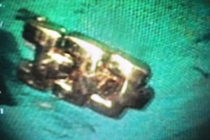 Dây đồng hồ kim loại 'chui tọt' vô bụng bé gái 3 tuổi