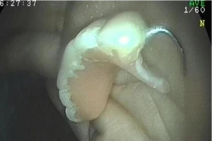 Nhiều người thủng bụng do xài… đồ giả 