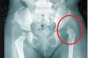 Trật khớp háng: Cần chữa sớm để trẻ không vẹo cột sống