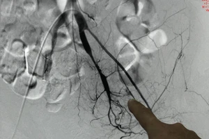 Bệnh nhân liên tục chảy máu không rõ nguyên nhân