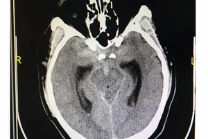 Tưởng đau đầu do làm đêm, té ra bị xuất huyết màng não