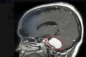 Cứu bệnh nhân có khối u não 'không giống ai'