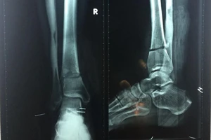 Bất cẩn suýt mất bàn chân vì máy cắt cỏ