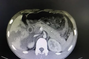 Bác sĩ 5 khoa của BV hợp lực cứu nạn nhân đa vết thương