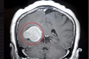 Khối u màng não to như trứng gà nằm chỗ hiểm