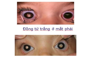 Vết trắng trong mắt trẻ và ung thư võng mạc