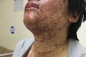 Mề đay nổi từng dề do tùy tiện uống thuốc cảm