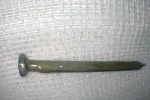 Bé trai gần 2 tuổi nuốt cây đinh dài 3 cm