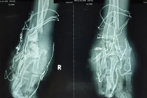 Học sinh 15 tuổi mất trọn bàn tay phải do pháo nổ