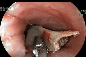 Bé gái 13 tuổi mắc xương đùi gà bự chảng trong cổ họng 