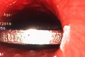 Bé gái 5 tuổi suýt chết vì đồng xu nghẹt ở thực quản