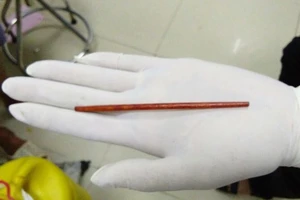 Hy hữu: Cây đũa 12 cm chui tọt vào trong niệu đạo