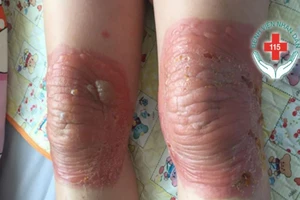 Suýt 'sụm bà chè' do bó gối bằng thuốc nam suốt 3 ngày