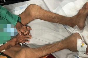 Chân tay biến dạng nặng do tự uống thuốc trị gút