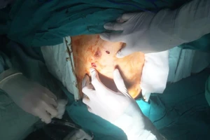 Cầm kéo đâm ngực mình khi đang chờ mổ chân