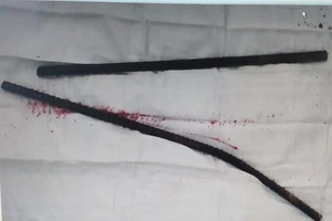 Té từ trên cao, bị 2 thanh sắt đâm xuyên đùi hông