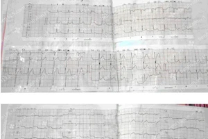 Virus siêu nhỏ nhưng gây viêm cơ tim cấp nguy hiểm