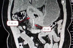 Nuốt tọt xương cá dài 5 cm vô bụng mà không biết