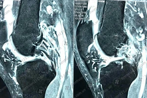 Đứt dây chằng, lỏng gối do té lúc đá banh