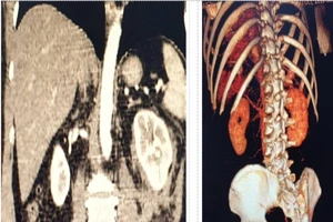 Lần đầu cứu bệnh nhân đứt mạch máu thận không phải mổ