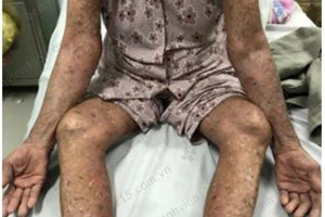 Cụ bà 83 tuổi đỏ da toàn thân do tự ý dùng thuốc trị gút