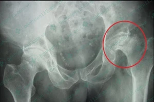 Hoại tử chỏm xương đùi vì uống rượu, hút thuốc quá nhiều