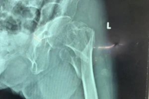 Nối các mảnh xương gãy cho cụ bà 101 tuổi