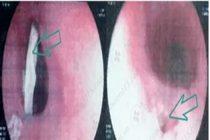 Suýt 'hết ăn Tết' vì cái xương gà