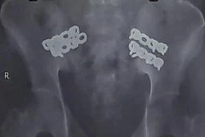 Người nhà đòi chuyển nạn nhân, BV giữ lại cứu sống