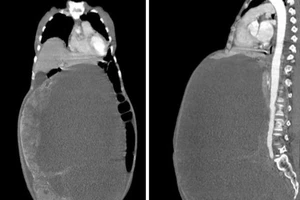 Cụ bà 78 tuổi “cõng” khối u buồng trứng 30 kg suốt nhiều năm