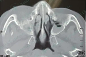 Nguy cơ tử vong vì viêm xoang trên bệnh nhân tiểu đường