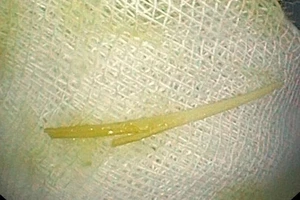 Thủng tá tràng vì vừa ngậm tăm vừa nói chuyện