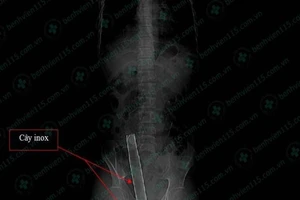 Vô bệnh viện cùng cây inox dài hơn 1m xuyên qua mông 