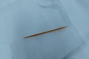 Tăm tre đâm xuyên gan, dạ dày suốt hai tháng mà không biết