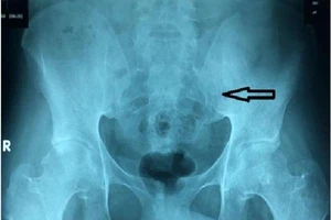 Suýt cứng khớp tay chân do nằm bất động 6 tháng trị cột sống