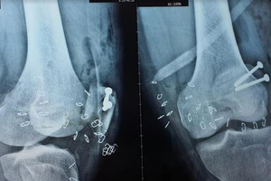 Người đàn ông bị chân vịt ca nô chém lộ xương chân