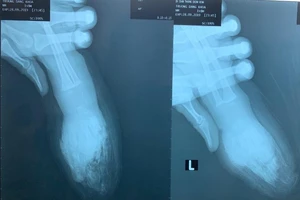 Người lớn sơ sẩy vài giây, bốn ngón tay bé một tuổi bị đứt lìa