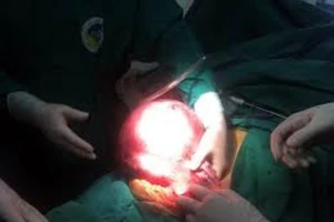  Sống cùng khối u nặng trên 6 kg suốt nhiều năm