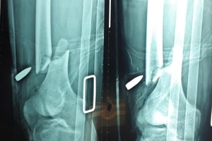 Vụ nổ súng ở Củ Chi: Nạn nhân bị thương đang được điều trị