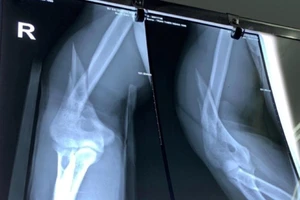 Gãy xương do vật tay quá trớn với bạn