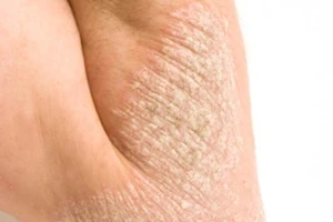 Bệnh vảy nến. Ảnh: Internet