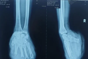 7 giờ căng thẳng nối bàn tay đứt lìa phức tạp