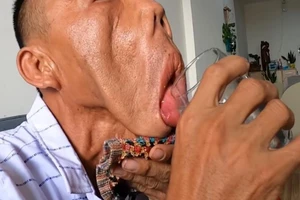 Nhiều năm phải ngủ ngồi do gương mặt chảy xệ, biến dạng