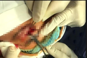 Bệnh nhân tâm thần tự móc mắt trong cơn kích động