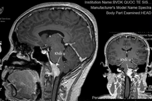 Tưởng chóng mặt do rối loạn tuần hoàn, té ra bị u não hiếm gặp